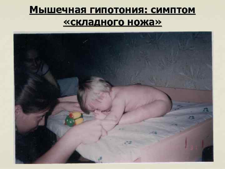Мышечная гипотония: симптом «складного ножа» 