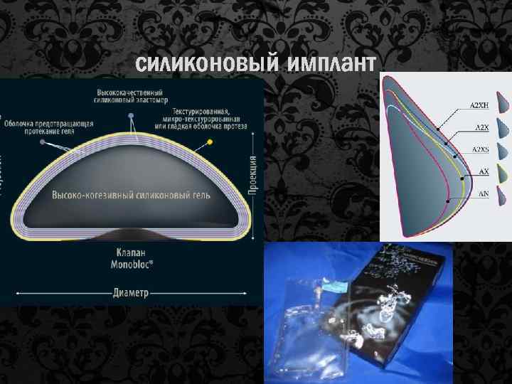 силиконовый имплант 