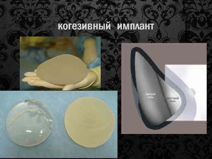 когезивный имплант 