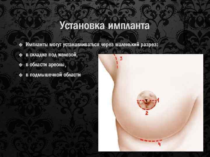 Установка импланта Импланты могут устанавливаться через маленький разрез: в складке под железой, в области