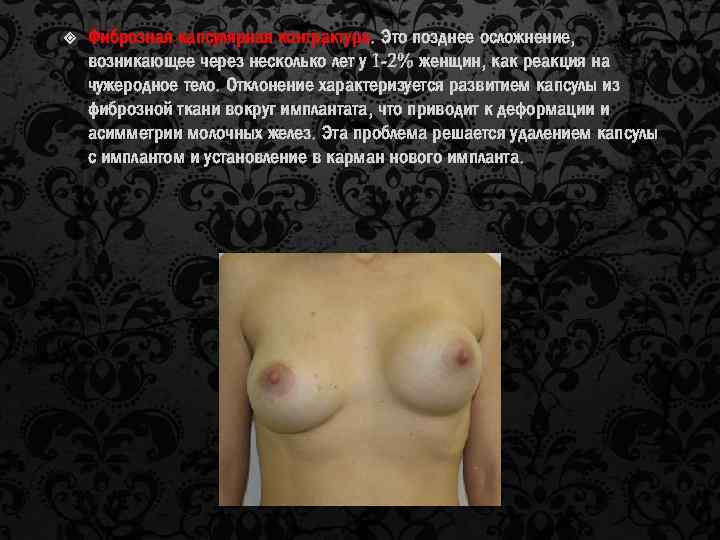  Фиброзная капсулярная контрактура. Это позднее осложнение, возникающее через несколько лет у 1 -2%