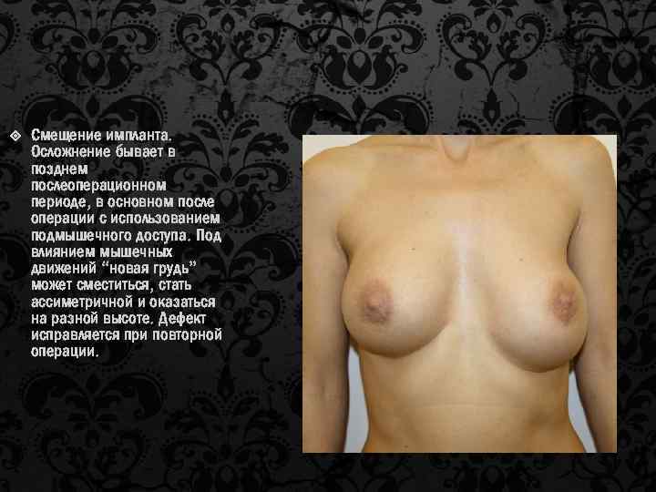  Смещение импланта. Осложнение бывает в позднем послеоперационном периоде, в основном после операции с