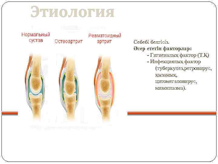 Этиология Себебі белгісіз. Әсер ететін факторлар: - Гигиеналық фактор (Т. Қ) - Инфекциялық фактор