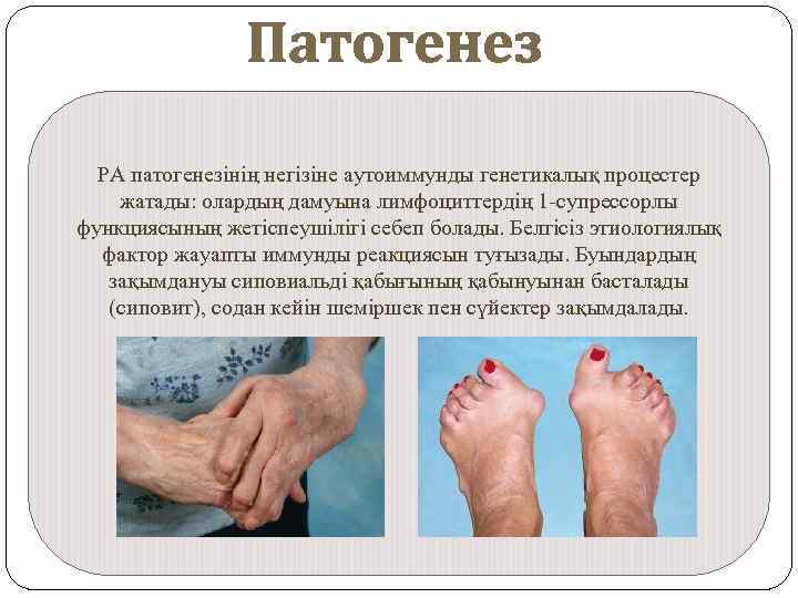 Патогенез РА патогенезінің негізіне аутоиммунды генетикалық процестер жатады: олардың дамуына лимфоциттердің 1 -супрессорлы функциясының