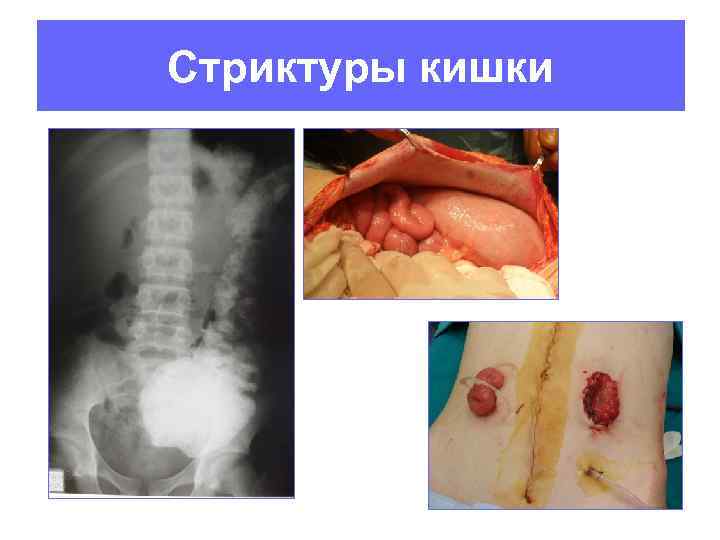 Стриктуры кишки 