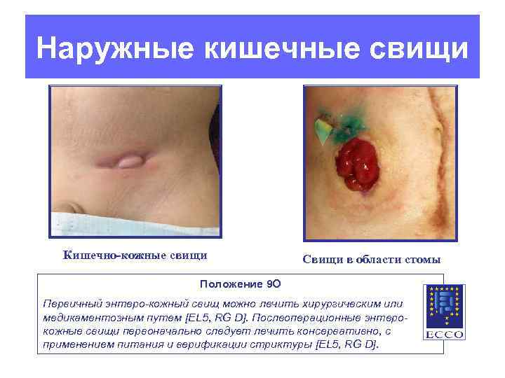 Наружные кишечные свищи Кишечно-кожные свищи Свищи в области стомы Положение 9 O Первичный энтеро-кожный
