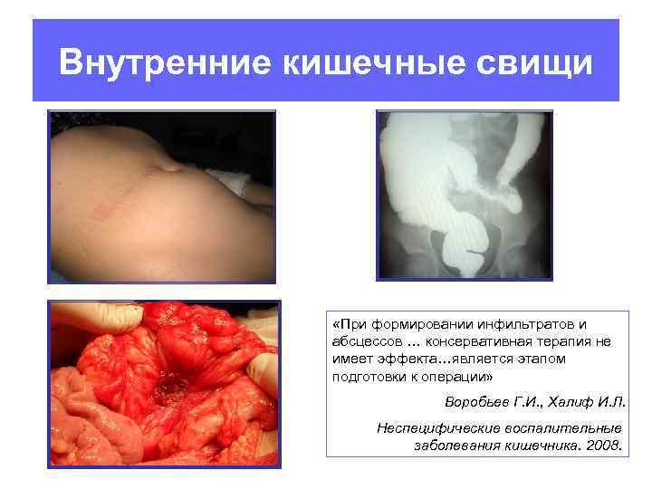 Внутренние кишечные свищи «При формировании инфильтратов и абсцессов … консервативная терапия не имеет эффекта…является