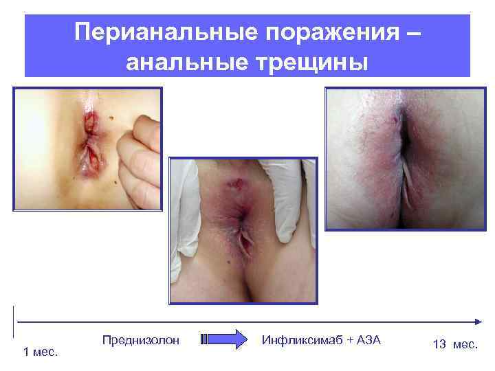 Перианальные поражения – анальные трещины 1 мес. Преднизолон Инфликсимаб + АЗА 13 мес. 