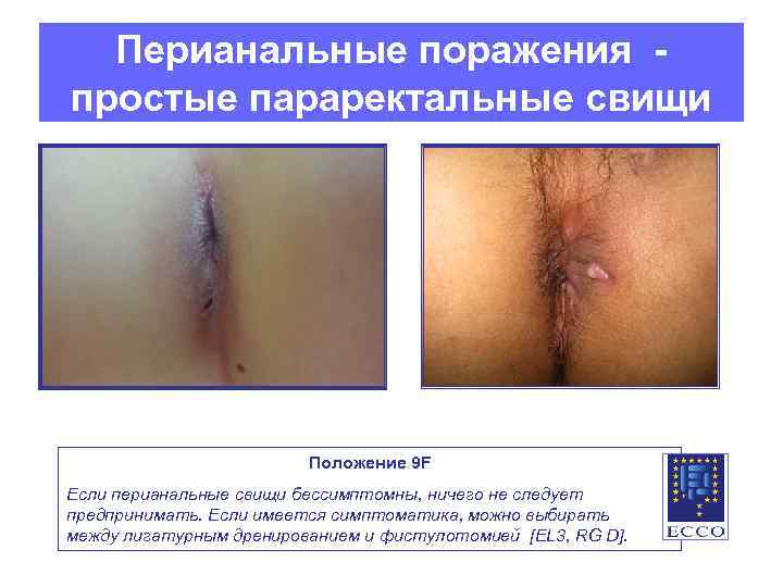 Перианальные поражения простые параректальные свищи Положение 9 F Если перианальные свищи бессимптомны, ничего не