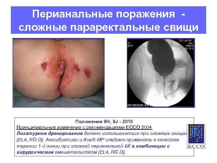 Перианальные поражения сложные параректальные свищи Положение 9 Н, 9 J - 2010 Принципиальные изменения