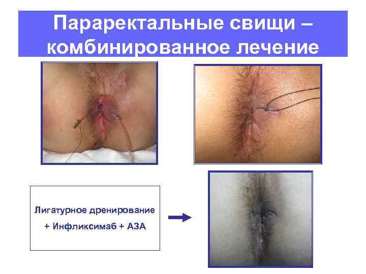 Параректальные свищи – комбинированное лечение Лигатурное дренирование + Инфликсимаб + АЗА 