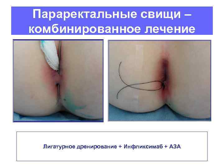 Параректальные свищи – комбинированное лечение Лигатурное дренирование + Инфликсимаб + АЗА 