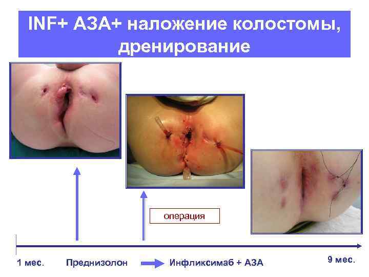 INF+ АЗА+ наложение колостомы, дренирование операция 1 мес. Преднизолон Инфликсимаб + АЗА 9 мес.