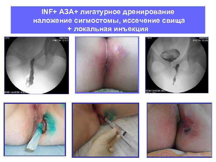 INF+ АЗА+ лигатурное дренирование наложение сигмостомы, иссечение свища + локальная инъекция 