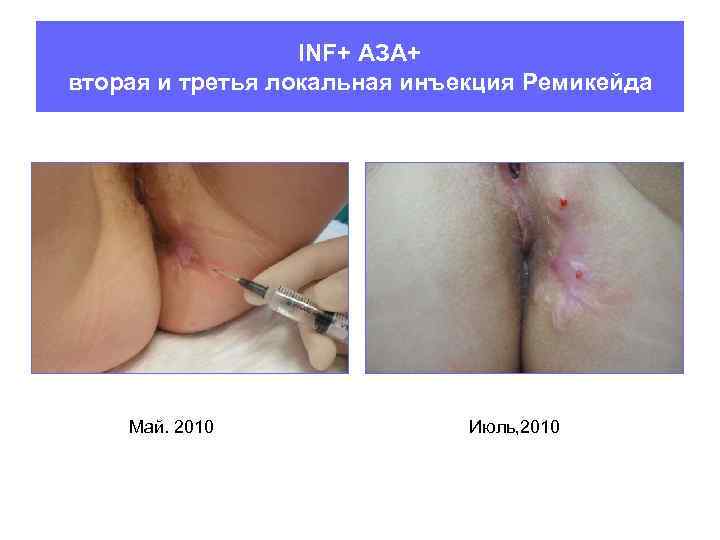 INF+ АЗА+ вторая и третья локальная инъекция Ремикейда Май. 2010 Июль, 2010 