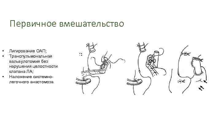 Первичное вмешательство • • • Лигирование ОАП; Транспульмональная вальвулотомия без нарушения целостности клапана ЛА;