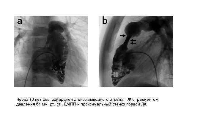 Через 13 лет был обнаружен стеноз выводного отдела ПЖ с градиентом давления 64 мм.