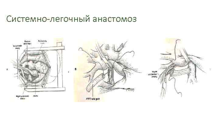 Системно-легочный анастомоз 