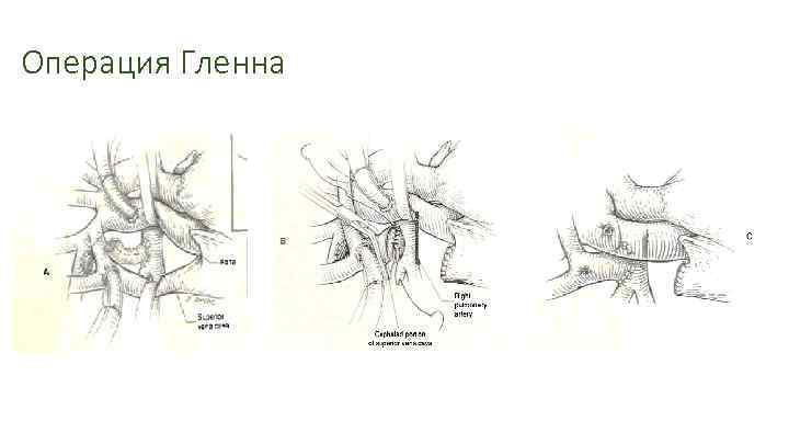 Операция Гленна 