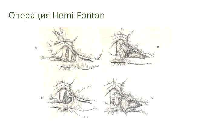 Операция Hemi-Fontan 