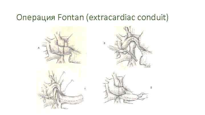 Операция Fontan (extracardiac conduit) 