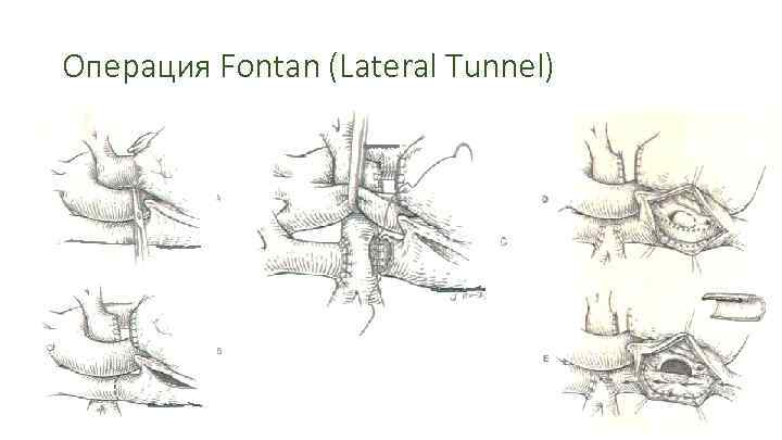 Операция Fontan (Lateral Tunnel) 