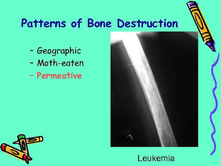 Patterns of Bone Destruction – Geographic – Moth-eaten – Permeative Leukemia 