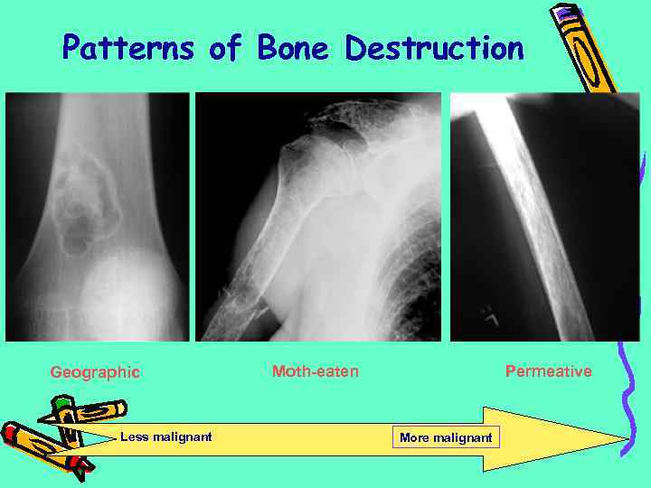 Patterns of Bone Destruction Geographic Less malignant Moth-eaten Permeative More malignant 