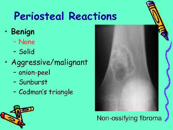 Periosteal Reactions • Benign – None – Solid • Aggressive/malignant – onion-peel – Sunburst
