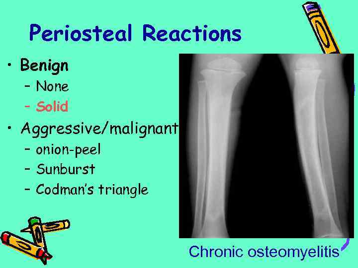 Periosteal Reactions • Benign – None – Solid • Aggressive/malignant – onion-peel – Sunburst