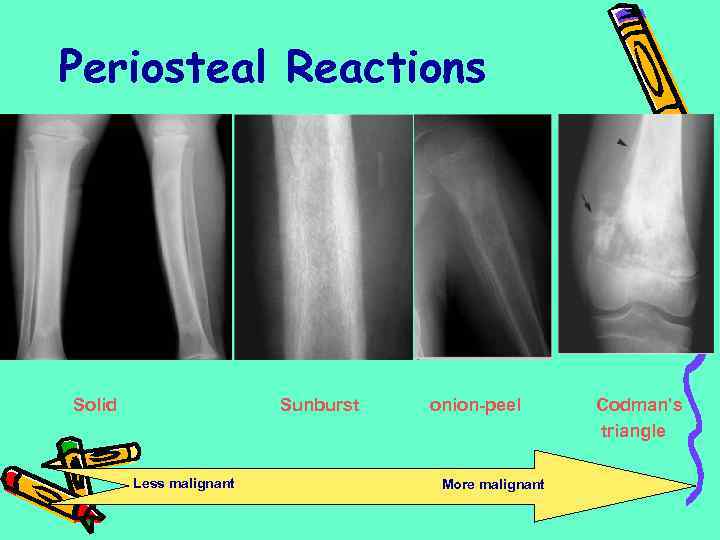 Periosteal Reactions Solid Sunburst Less malignant onion-peel More malignant Codman’s triangle 