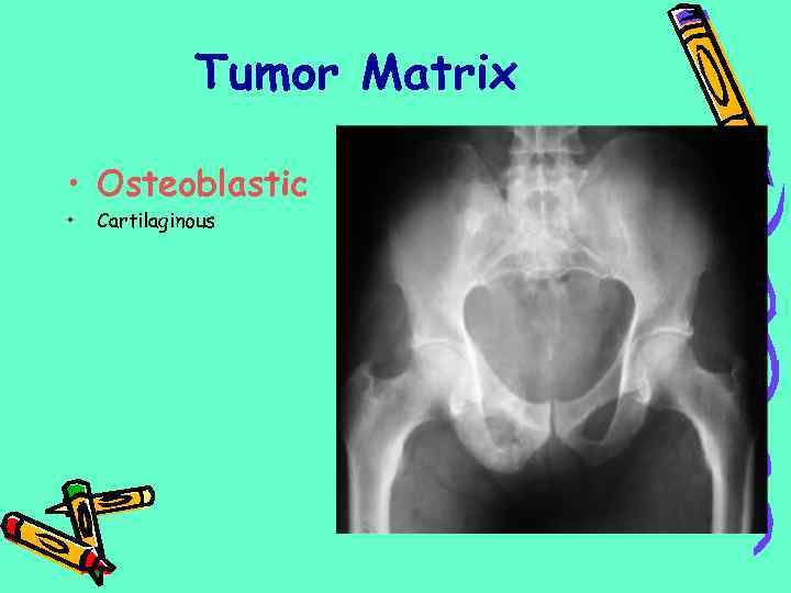 Tumor Matrix • Osteoblastic • Cartilaginous 