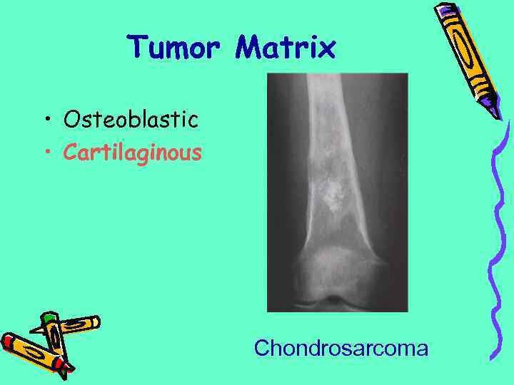 Tumor Matrix • Osteoblastic • Cartilaginous Chondrosarcoma 