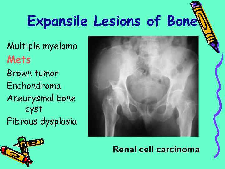 Expansile Lesions of Bone Multiple myeloma Mets Brown tumor Enchondroma Aneurysmal bone cyst Fibrous