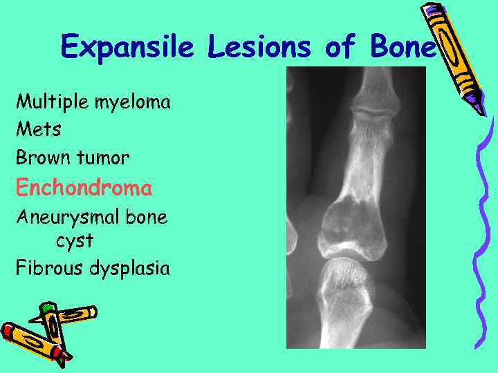 Expansile Lesions of Bone Multiple myeloma Mets Brown tumor Enchondroma Aneurysmal bone cyst Fibrous