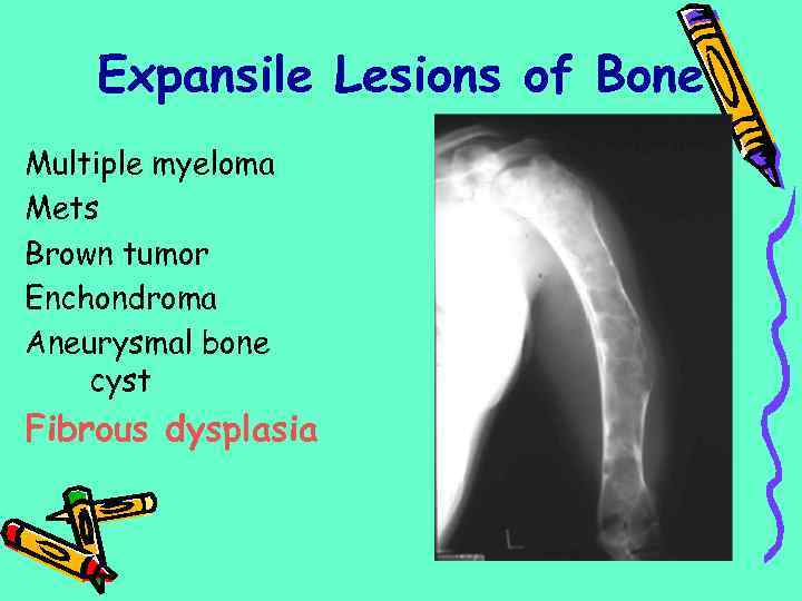 Expansile Lesions of Bone Multiple myeloma Mets Brown tumor Enchondroma Aneurysmal bone cyst Fibrous