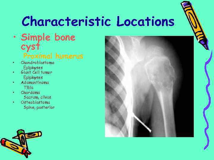 Characteristic Locations • Simple bone cyst • • • Proximal humerus Chondroblastoma Epiphyses Giant