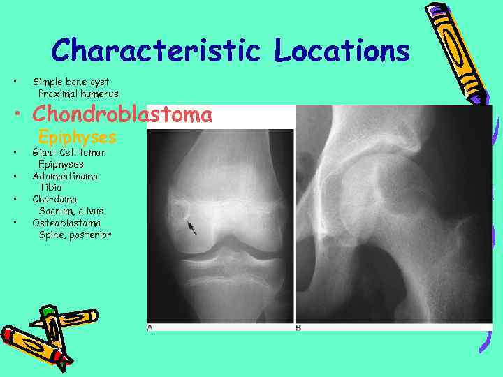 Characteristic Locations • Simple bone cyst Proximal humerus • Chondroblastoma • • Epiphyses Giant