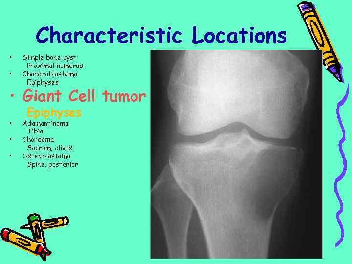 Characteristic Locations • • Simple bone cyst Proximal humerus Chondroblastoma Epiphyses • Giant Cell