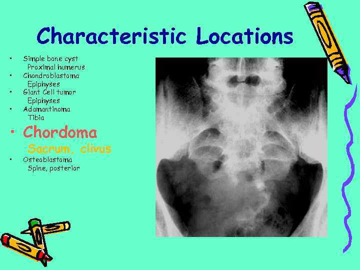 Characteristic Locations • • Simple bone cyst Proximal humerus Chondroblastoma Epiphyses Giant Cell tumor