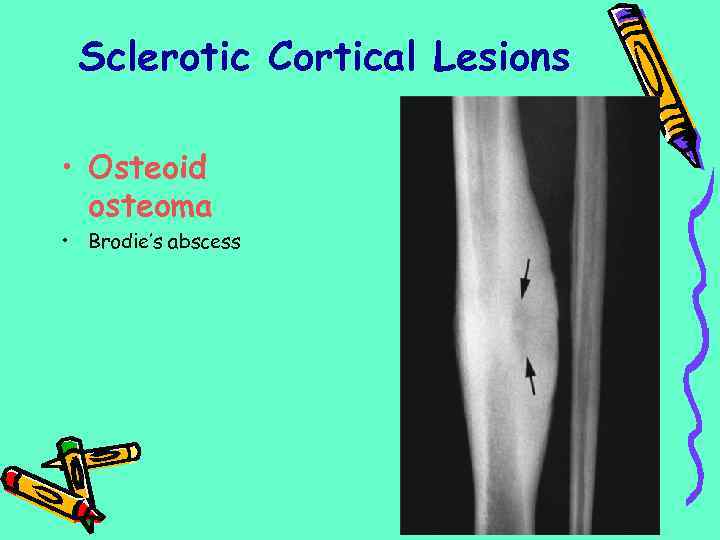 Sclerotic Cortical Lesions • Osteoid osteoma • Brodie’s abscess 