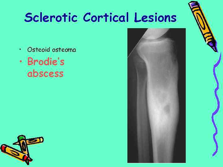 Sclerotic Cortical Lesions • Osteoid osteoma • Brodie’s abscess 