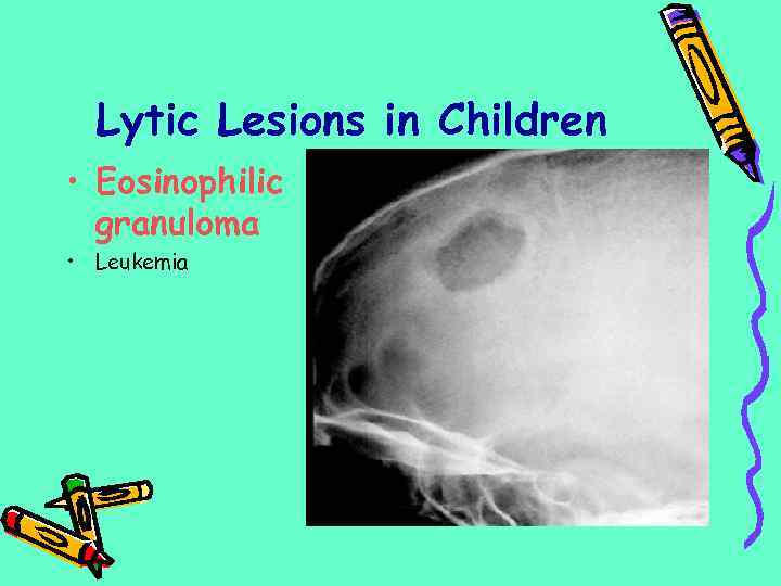 Lytic Lesions in Children • Eosinophilic granuloma • Leukemia 