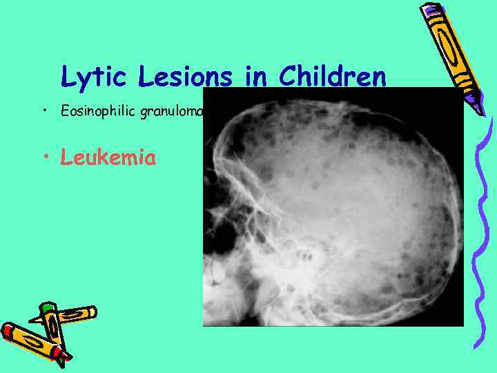 Lytic Lesions in Children • Eosinophilic granuloma • Leukemia 