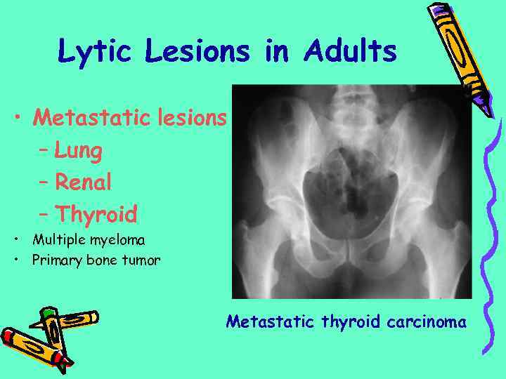 Lytic Lesions in Adults • Metastatic lesions – Lung – Renal – Thyroid •