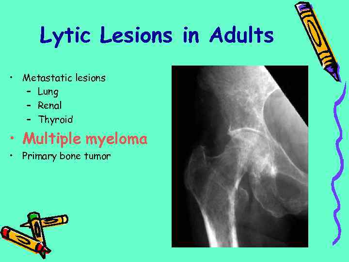 Lytic Lesions in Adults • Metastatic lesions – Lung – Renal – Thyroid •