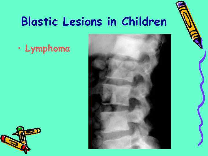 Blastic Lesions in Children • Lymphoma 