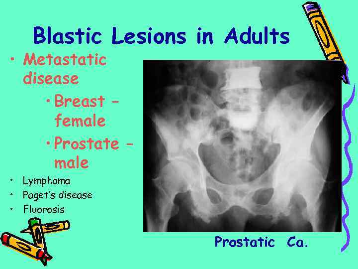 Blastic Lesions in Adults • Metastatic disease • Breast – female • Prostate –