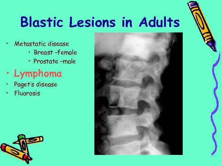 Blastic Lesions in Adults • Metastatic disease • Breast –female • Prostate –male •