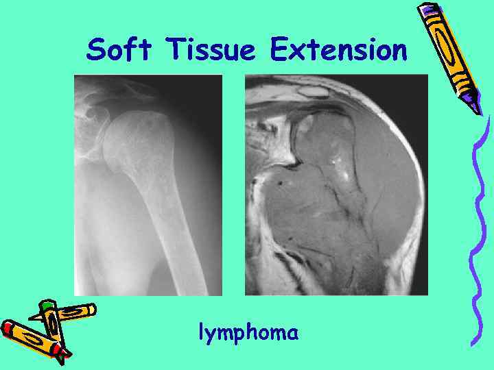 Soft Tissue Extension lymphoma 